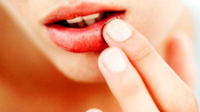Болячки, подразнення в куточках губ(герпес): причини, лікування