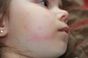 Порятунок від укусів комарів і алергії. Краплі для дітей Фенистил. Інструкція та протипоказання.