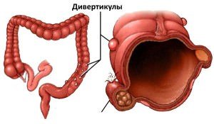 Симптоматика та лікування дивертикулеза