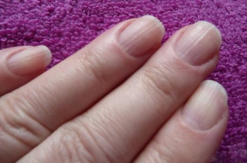 Діагностика по нігтям: про що говорять поздовжні смуги на нігтях?