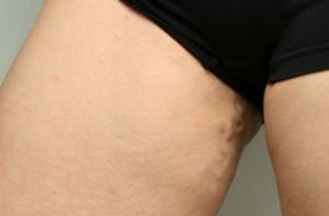 Симптоми варикозу вен на ногах, малого тазу, яєчок у чоловіків, матки, стравоходу: як виглядає варикозне розширення вен