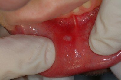 Висип і роздратування навколо рота у дитини: причини червоних плям