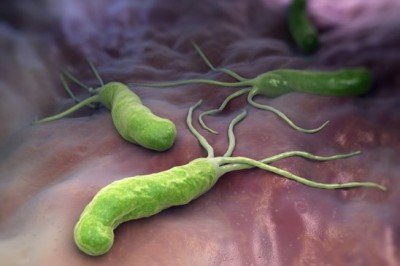 Бактерія хелікобактер пілорі в шлунку: симптоми, лікування