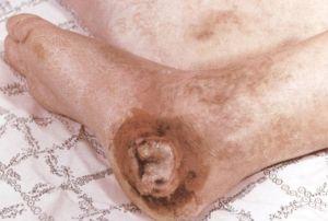 Облітеруючий ендартеріїт нижніх кінцівок ( хвороба Бюргера)