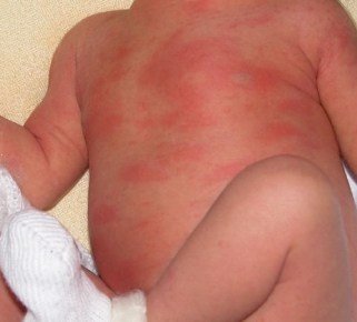 Токсична еритема у новонароджених   що за недуга? Які причини? Необхідне лікування?