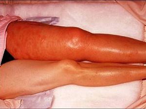 Причини і симптоми тромбозу вен нижніх кінцівок, глибоких вен, кишечника та інших видів