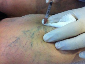 Капілярна сітка на ногах: хвороба або косметичний дефект?