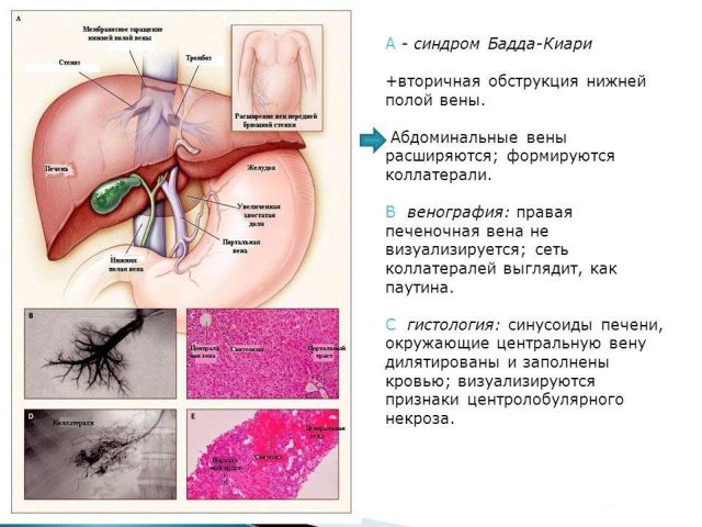 Синдром бадда кіарі (облітеруючий флебіт печінкових вен): лікування та прогноз