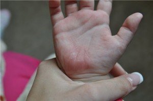 Шершаві плями на шкірі у дитини