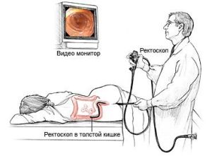 Діагностична аноскопия: відео, відгуки, підготовка і хід дослідження