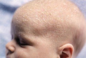 Лущення шкіри у немовляти: причини, види, лікування, профілактика