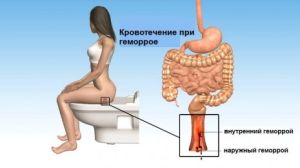 Чи можна ходити в лазню і паритися при геморої: вплив на організм