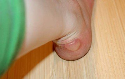 Лікування сухої мозолі між пальцями ніг: як прибрати?