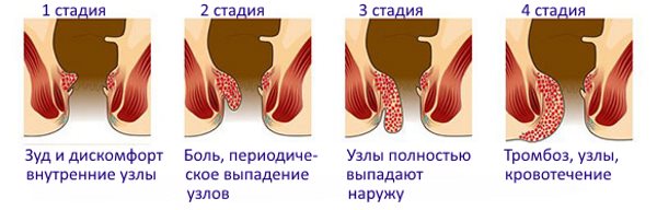 Що робити, коли болить геморой