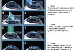 Операція на очі лазером: протипоказання, наслідки, можливі побічні ефекти (відео)
