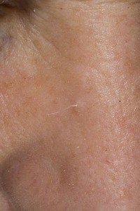 Трихофолликулома: клинические и дерматоскопические признаки | DERMATOLOGY-ONLINE | Дзен