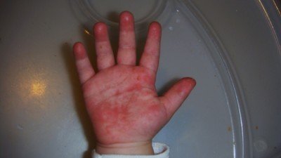 Червоні плями (крапки) на долонях у дитини (хвороба Лані), сверблять: причини