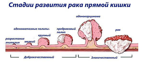 Як проводять операцію з видалення прямої кишки