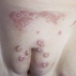 Пелюшковий дерматит стафілококовий   причини, симптоми, лікування, фото