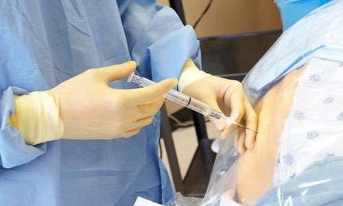 Епідуральна анестезія