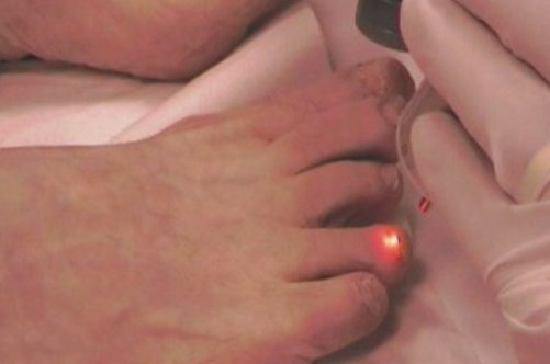 Лікування екземи нігтів: ефективна методика