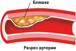 Операція стентування судин серця: показання, післяопераційна реабілітація (відео)