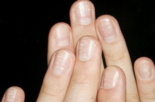 Чому у вас хвилясте нігті на руках: причина захворювання