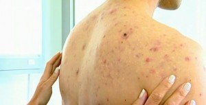 Висип на плечах: причини, види, лікування