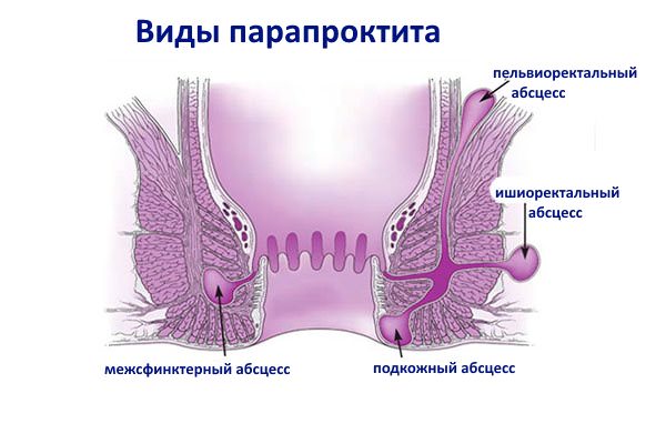 Лікування парапроктита ректальними суппотизориями