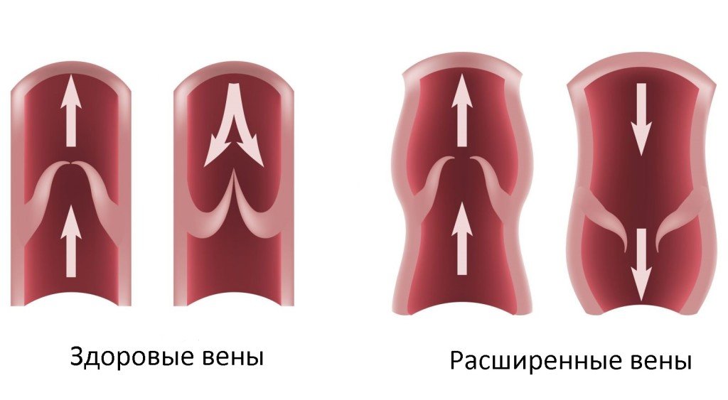 Потрібна ходьба при варикозі і яка користь від цього?