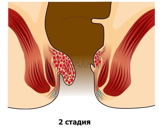 Як лікувати тромбоз зовнішнього гемороїдального вузла