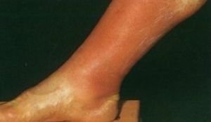 Симптоми тромбофлебіту нижніх кінцівок