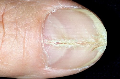 Поздовжнє розшарування нігтів: як це вилікувати?