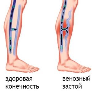 Венозний застій в ногах, голові, малому тазі, в легенях: лікування