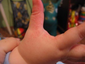 Висип на пальцях рук: причини появи