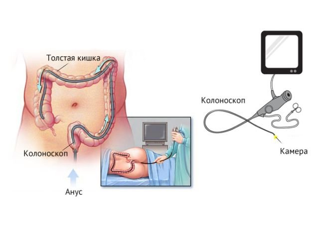 Колоноскопія кишечника: підготовка до процедури, як проходить, чи боляче це, відео