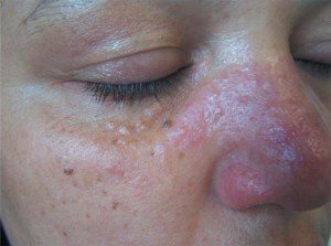 Як лікувати купероз на носі і на крилах носа в домашніх умовах?