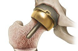 Операції при переломі шийки стегна: реабілітація та можливі ускладнення (відео)