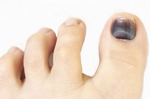 Гематома під нігтем великого пальця на нозі: як прискорити лікування?