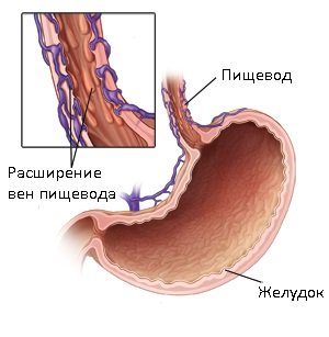 Склерозування вен нижніх кінцівок: для чого це потрібно?