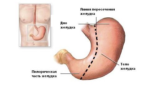 Операція по зменшенню шлунка