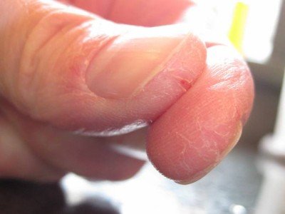 Чому тріскається шкіра на пальцях рук: лікування, що робити якщо лущитися і сохне