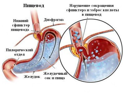 Звуження (стеноз, стриктура) стравоходу: симптоми, причини, лікування