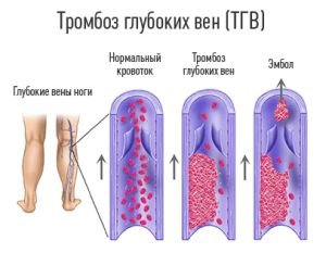 Тромбоз підколінної вени: симптоми, діагностика, лікування