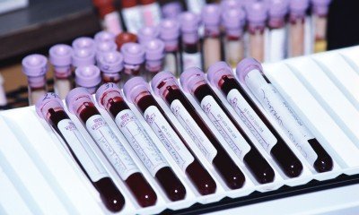 Аналіз крові АСТ і АЛТ: що це таке, розшифровка, норма у жінок, чоловіків