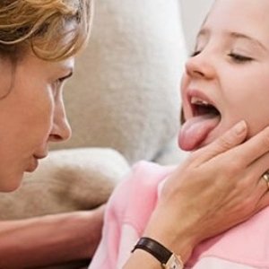 Як правильно лікується герпесная ангіна у дітей? Скільки триває захворювання?