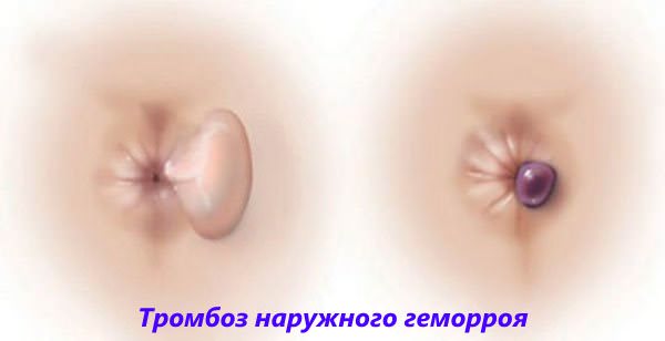 Несе геморой небезпека для здоровя?