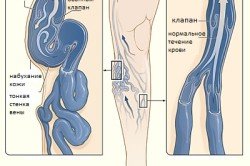 Видалення вен на ногах: операції при варикозі