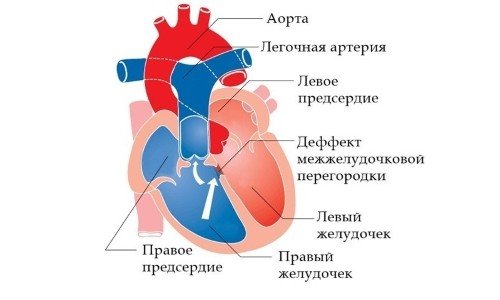 Операції на серці: показання та види, реабілітаційний період (відео)