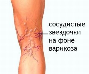 Від чого зявляються судинні зірочки на ногах: лікування, причини, симптоми